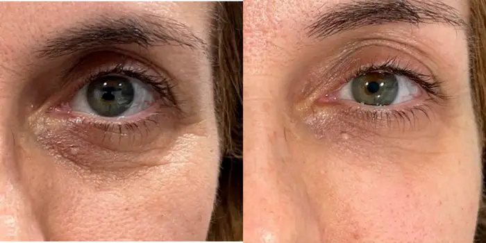 Relleno de ojeras (2)