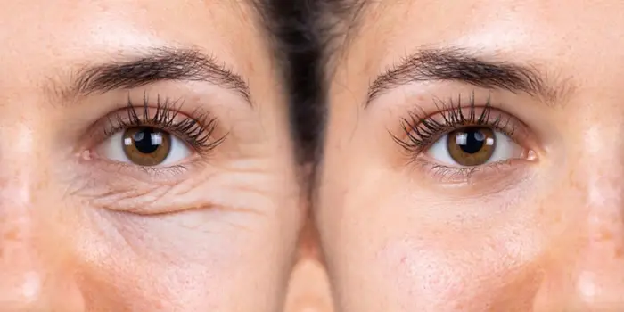 Relleno de ojeras (1)