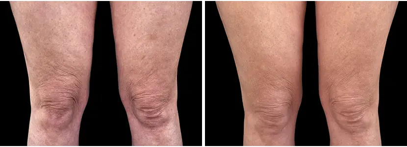 piernas02