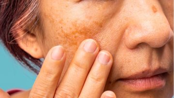 MANCHAS Y CICATRICES