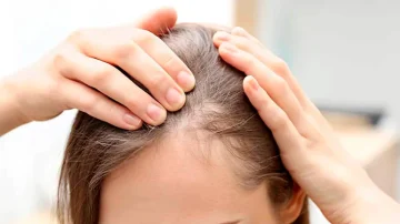 alopecia